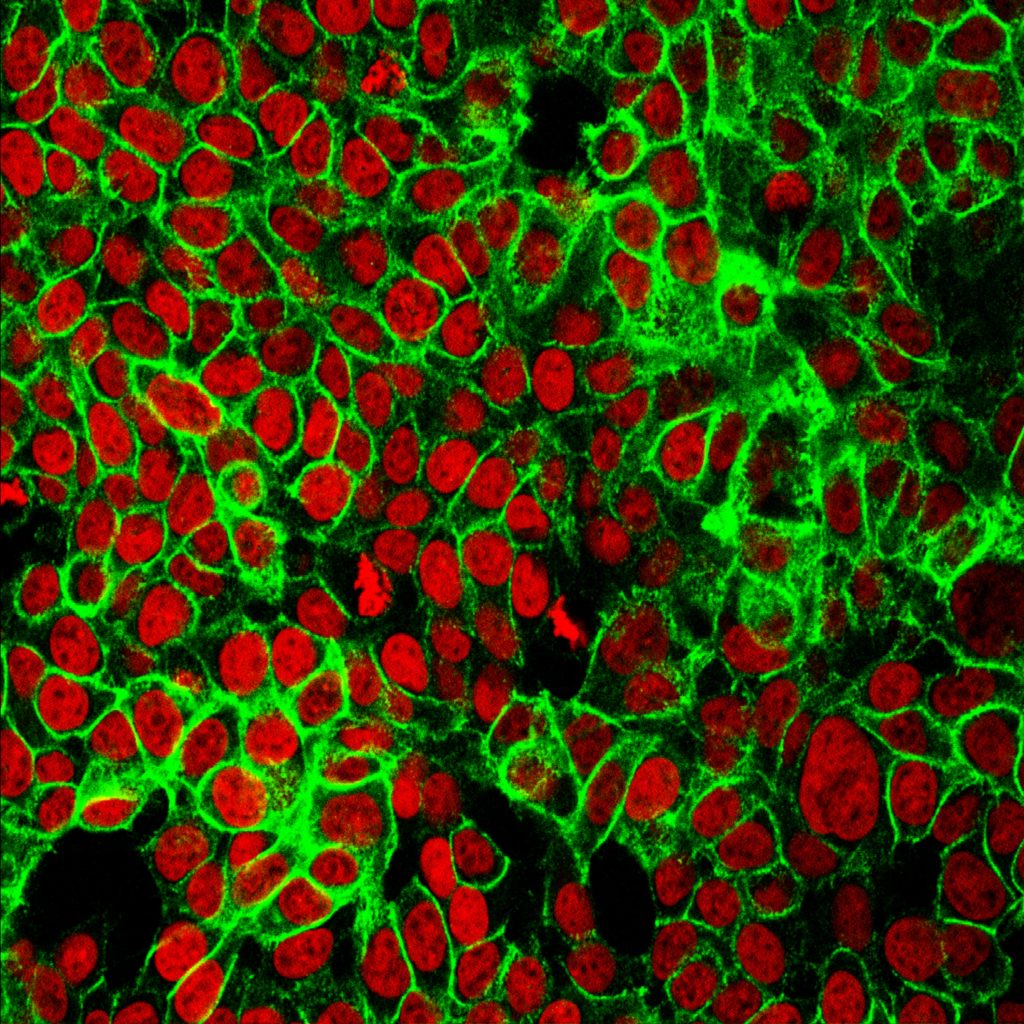 Human colon cancer cells with the cell nuclei stained red and the protein E-cadherin stained green. E-cadherin is a cell adhesion molecule and its loss signals a process known as the epithelial-mesenchymal transition in which cells acquire the ability to migrate and become invasive.